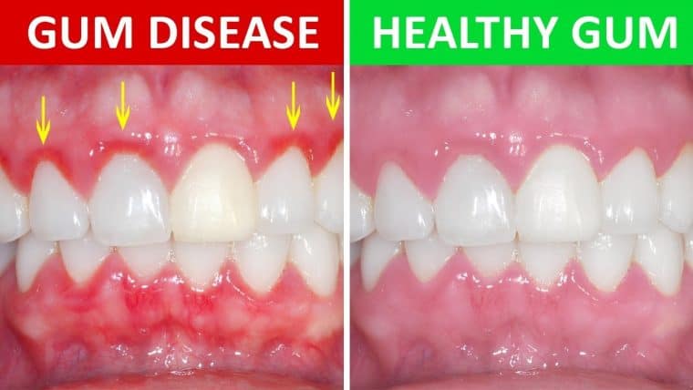 gum disease versus healthy gum