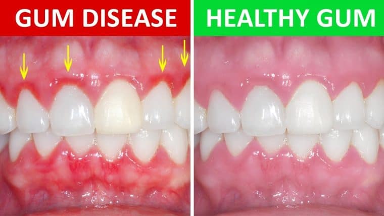 7 Trusting How To Tell If You Have Gum Disease Latest