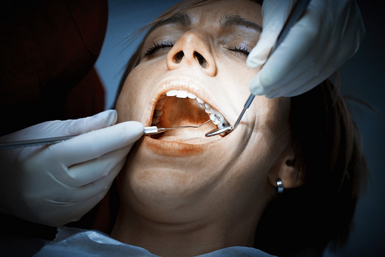 tooth abscess stages - dentist examining a patients teeth at the dental clinic